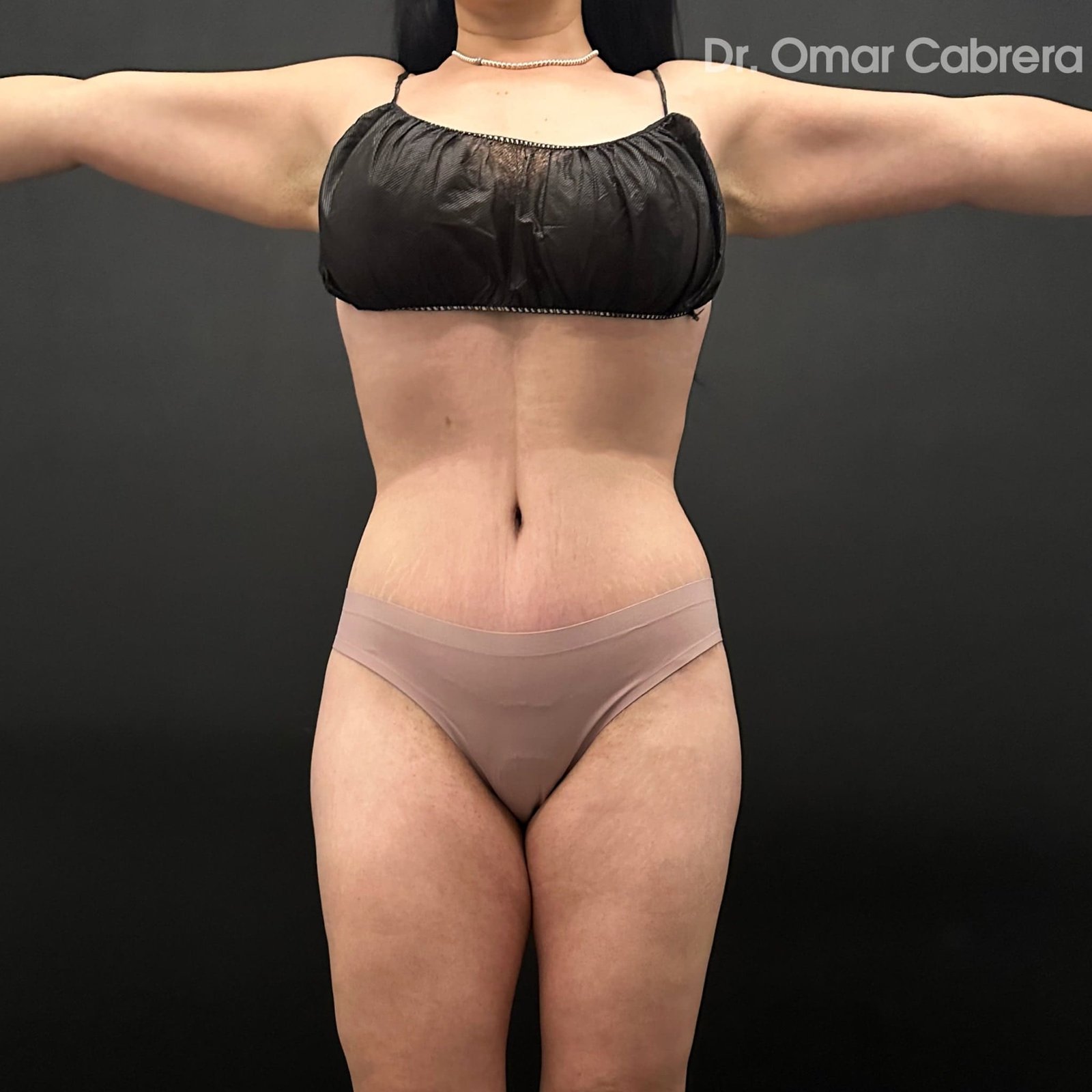 Abdominoplastia y Tummy Tuck Tijuana. Dr Omar Cabrera (2)