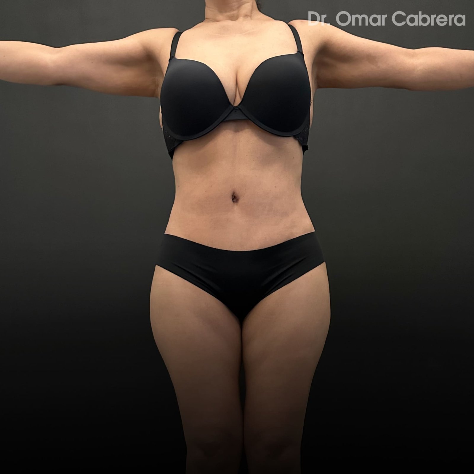 Abdominoplastia y Tummy Tuck Tijuana. Dr Omar Cabrera (3)