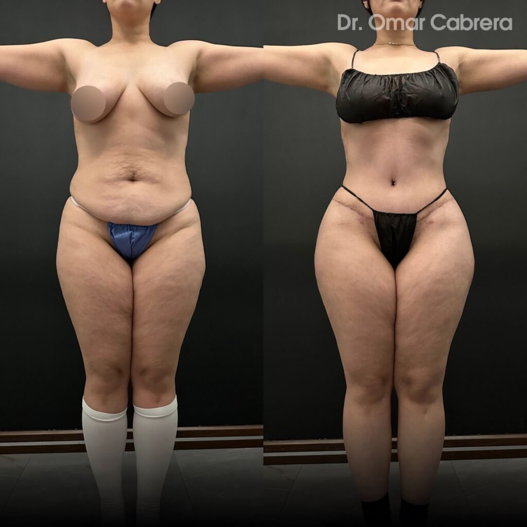 Abdominoplastia y Tummy Tuck Tijuana. Dr Omar Cabrera (4)