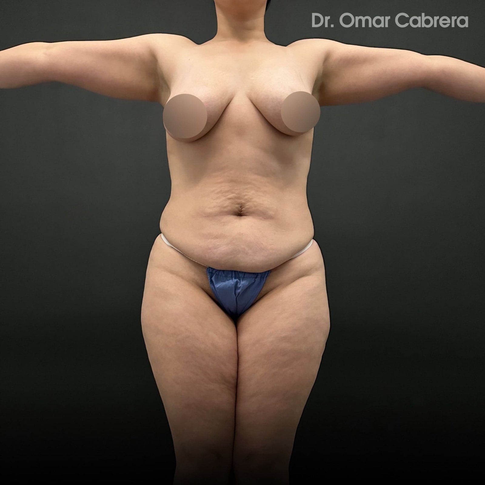 Abdominoplastia y Tummy Tuck Tijuana. Dr Omar Cabrera (5)