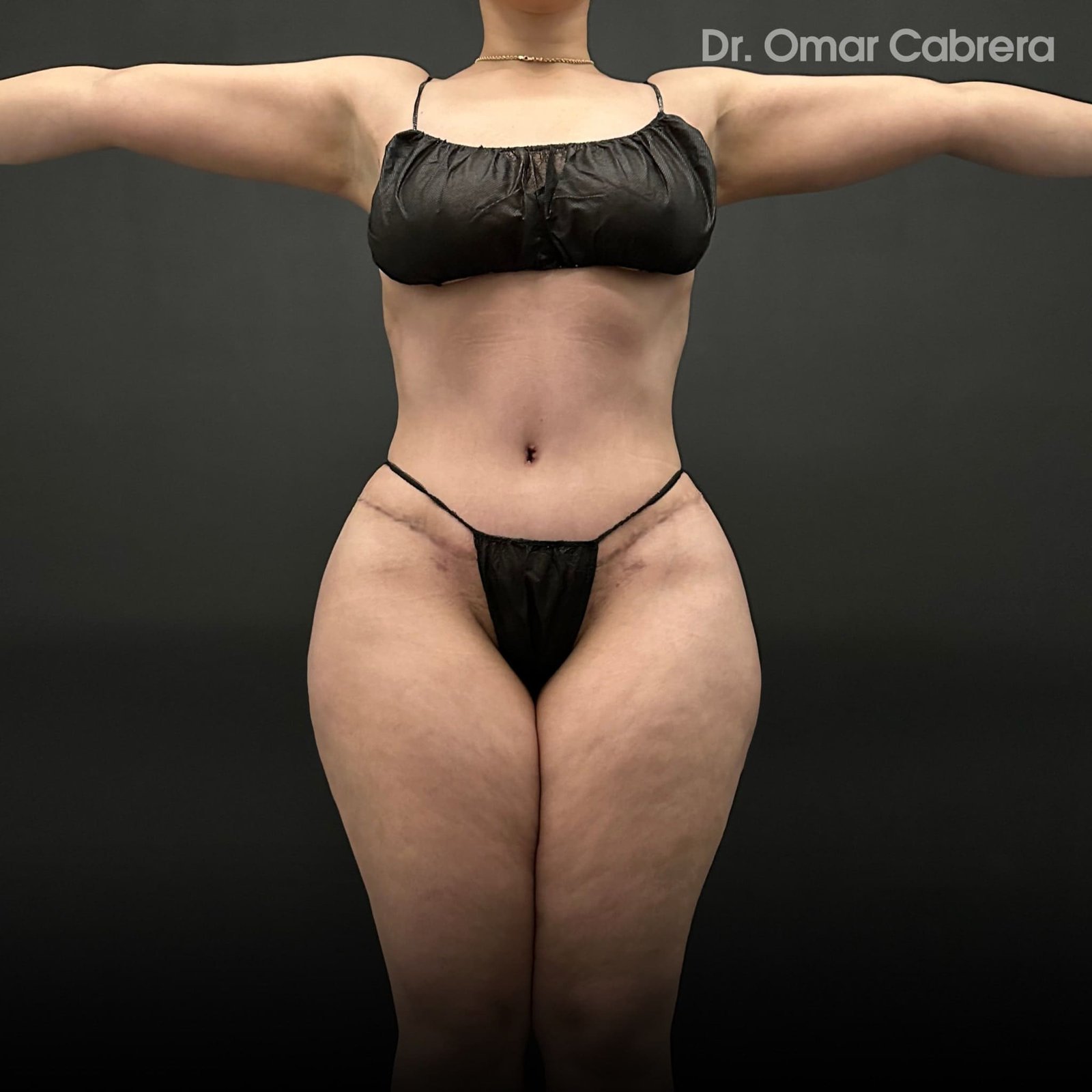 Abdominoplastia y Tummy Tuck Tijuana. Dr Omar Cabrera (6)