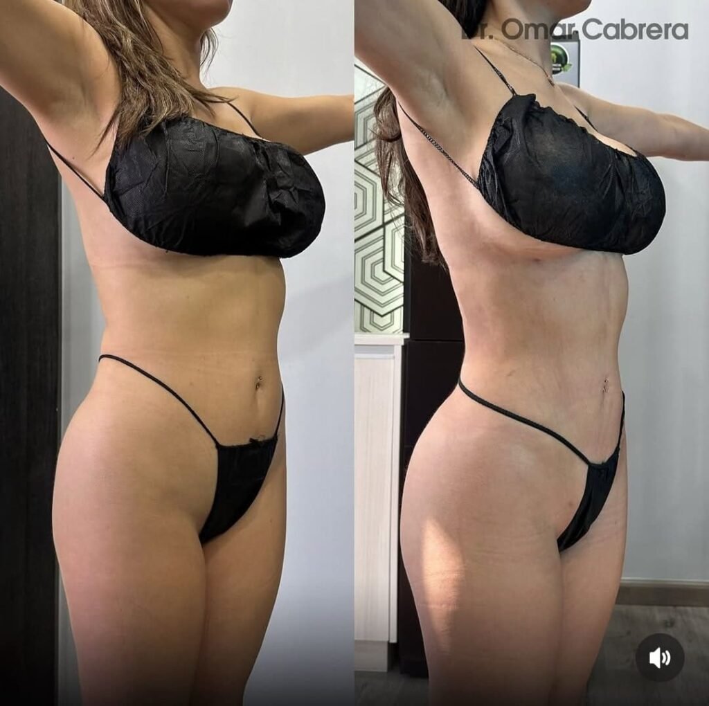 Lipo 360 y Lipoescultura Tijuana. Dr Omar Cabrera (28)