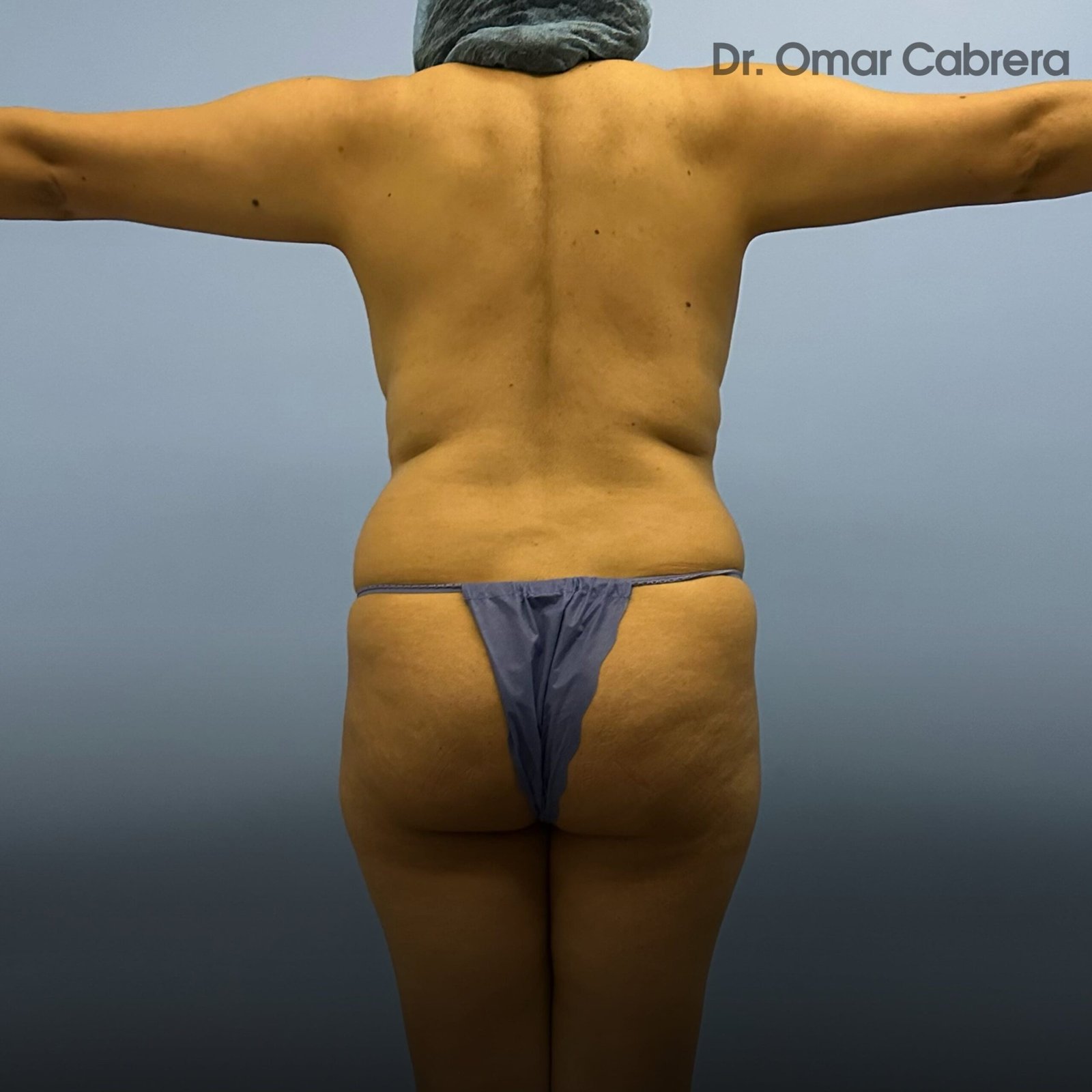 Mommy Makeover Tijuana. Dr Omar Cabrera (1)