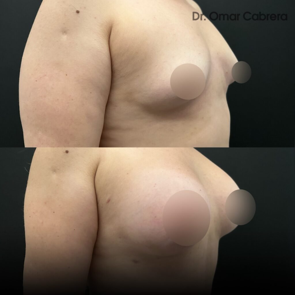 Aumento de Busto en Tijuana. Dr Omar Cabrera. Cirujano Plastico en Tijuana (3)