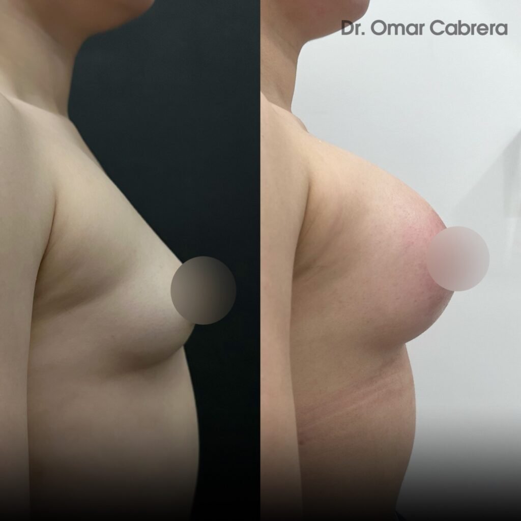 Aumento de Busto en Tijuana. Dr Omar Cabrera. Cirujano Plastico en Tijuana (3)