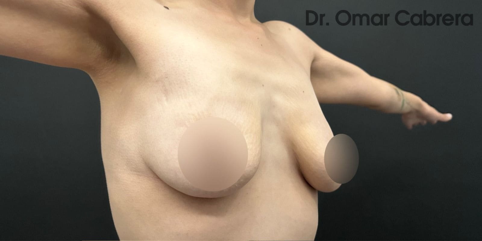 Mastopexia con Implantes en Tijuana. Dr Omar Cabrera (1)-min