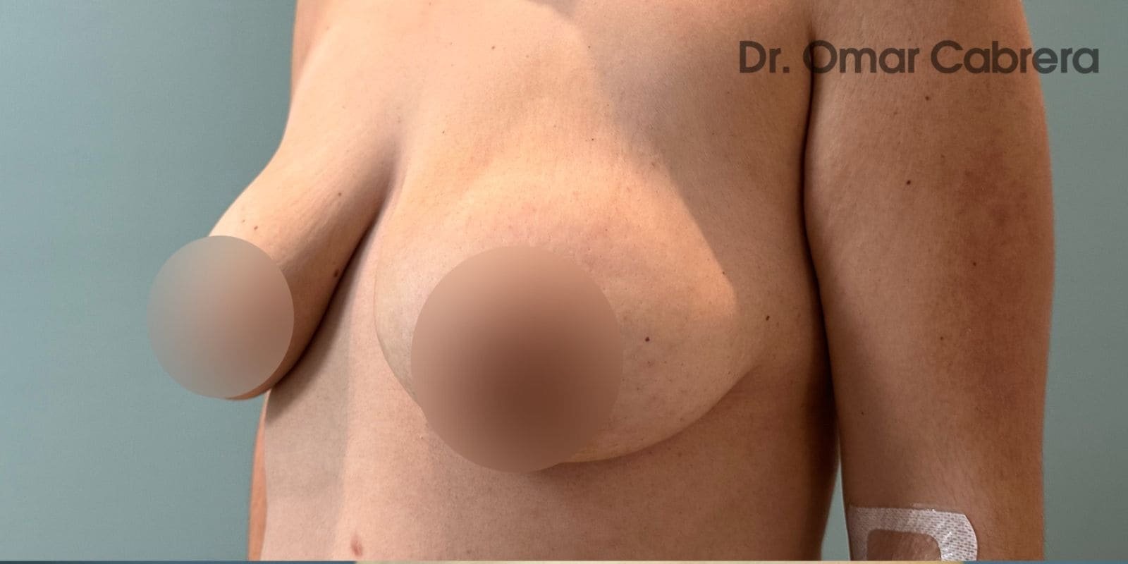 Mastopexia con Implantes en Tijuana. Dr Omar Cabrera (3)-min