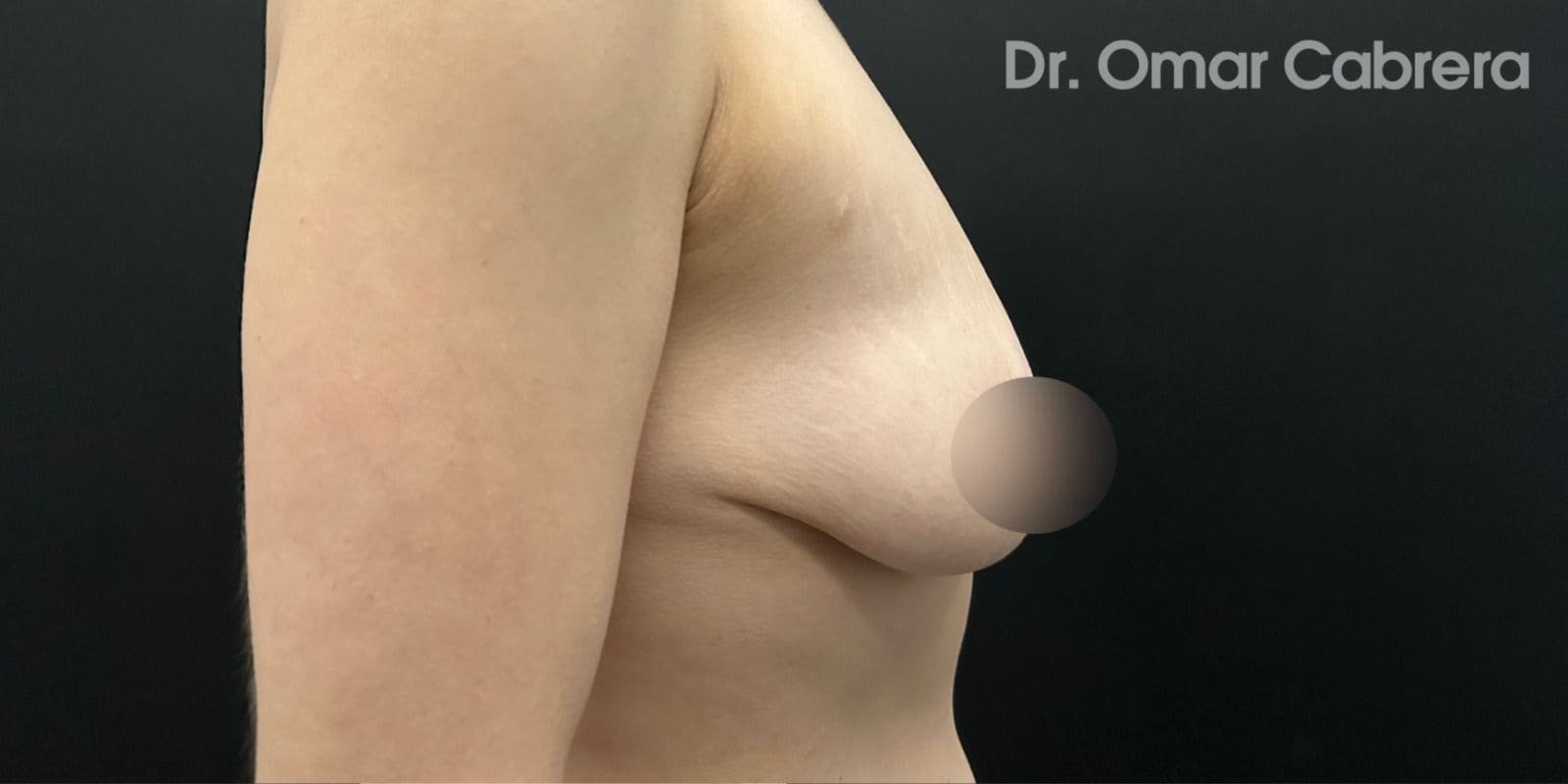 Mastopexia con Implantes en Tijuana. Dr Omar Cabrera (5)-min