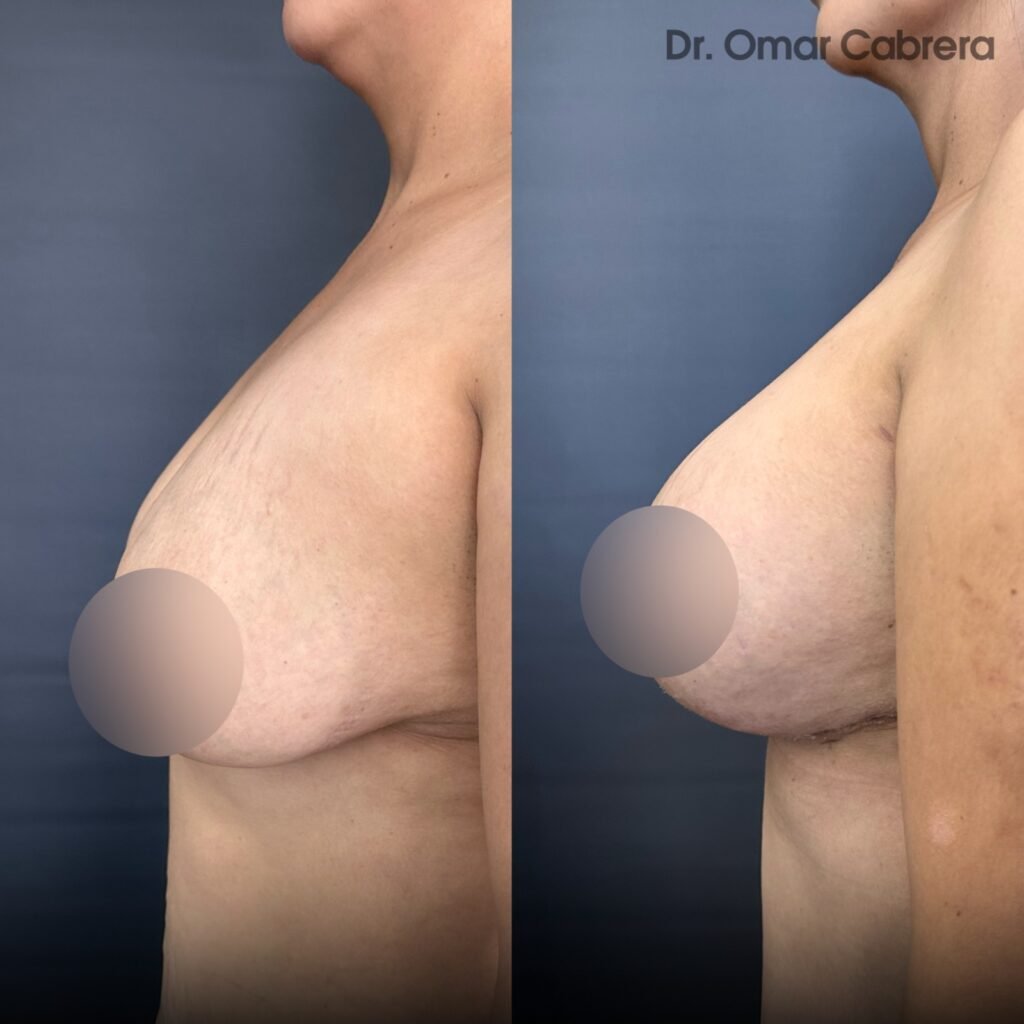 Mastopexia con Implantes en Tijuana. Dr Omar Cabrera. Cirujano Plastico en Tijuana Mexico (2)