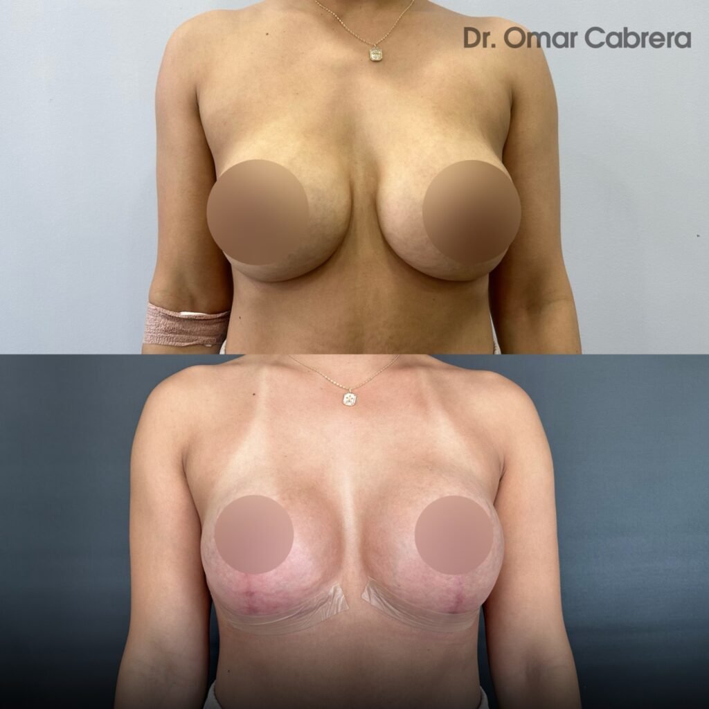 Mastopexia con Implantes en Tijuana. Dr Omar Cabrera. Cirujano Plastico en Tijuana Mexico (4)