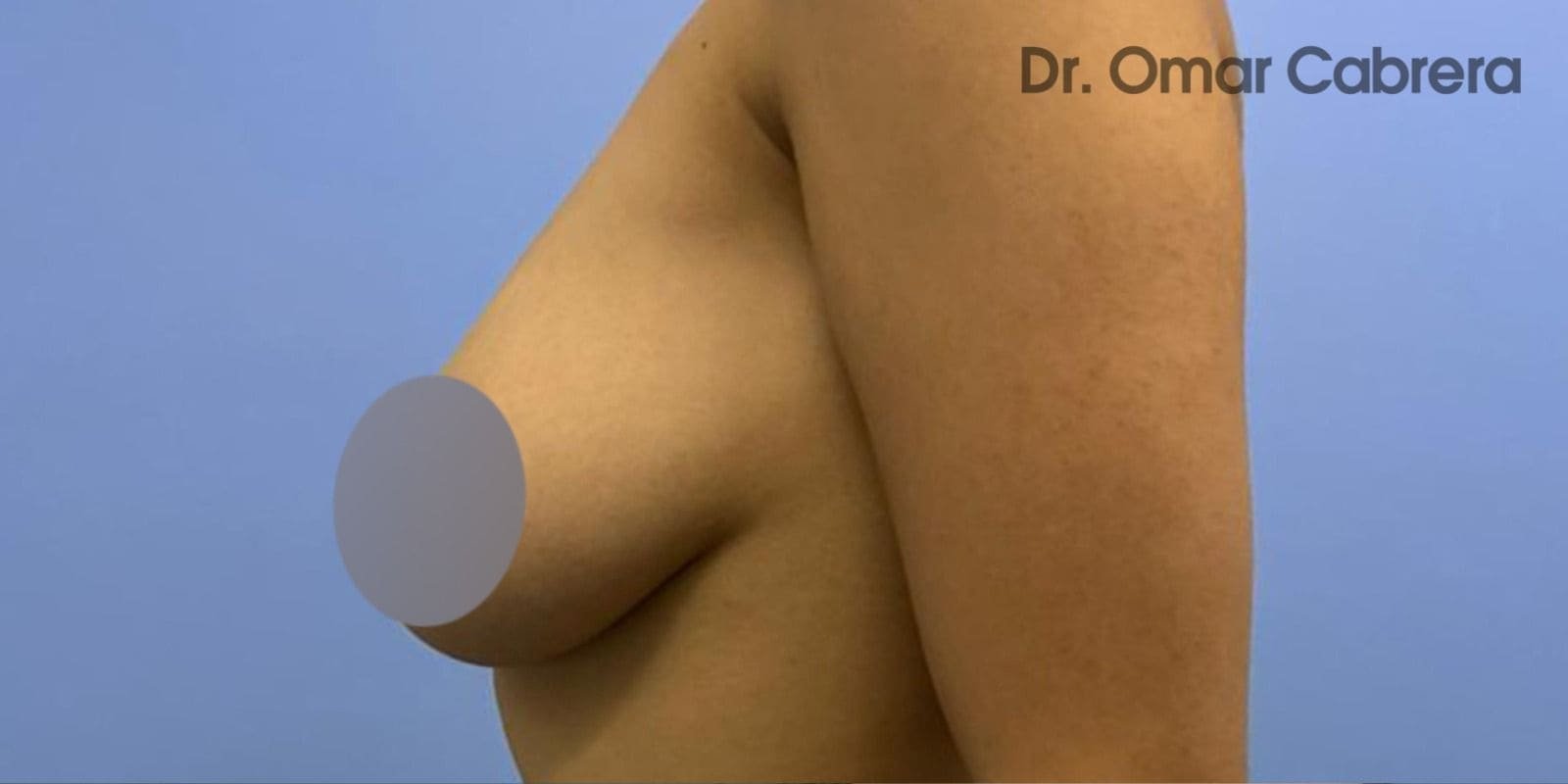 Mastopexia sin Implantes en Tijuana. Dr Omar Cabrera. Cirujano Plastico en Tijuana Mexico (1)