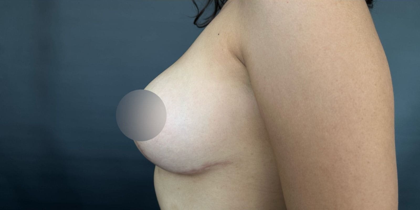 Mastopexia sin Implantes en Tijuana. Dr Omar Cabrera. Cirujano Plastico en Tijuana Mexico (2)