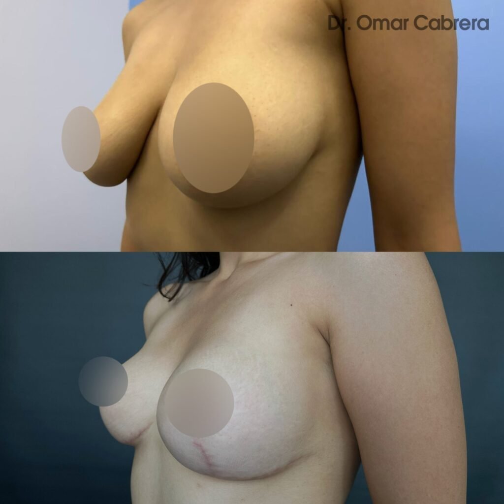 Mastopexia sin Implantes en Tijuana. Dr Omar Cabrera. Cirujano Plastico en Tijuana Mexico (3)