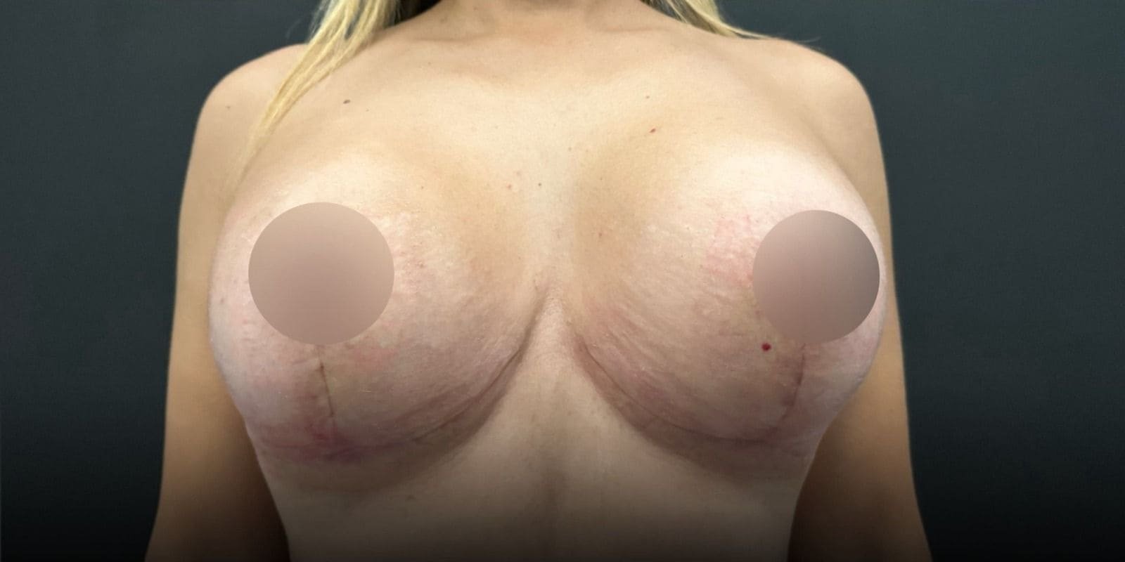 Mastopexia sin Implantes en Tijuana. Dr Omar Cabrera. Cirujano Plastico en Tijuana Mexico (4)