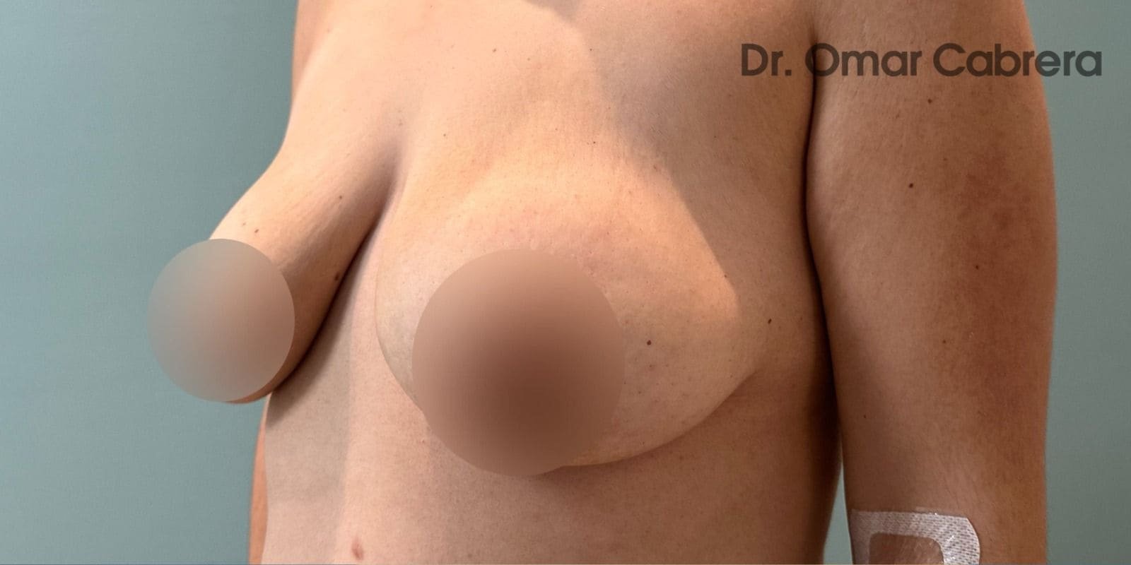 Mastopexia sin Implantes en Tijuana. Dr Omar Cabrera. Cirujano Plastico en Tijuana Mexico (5)