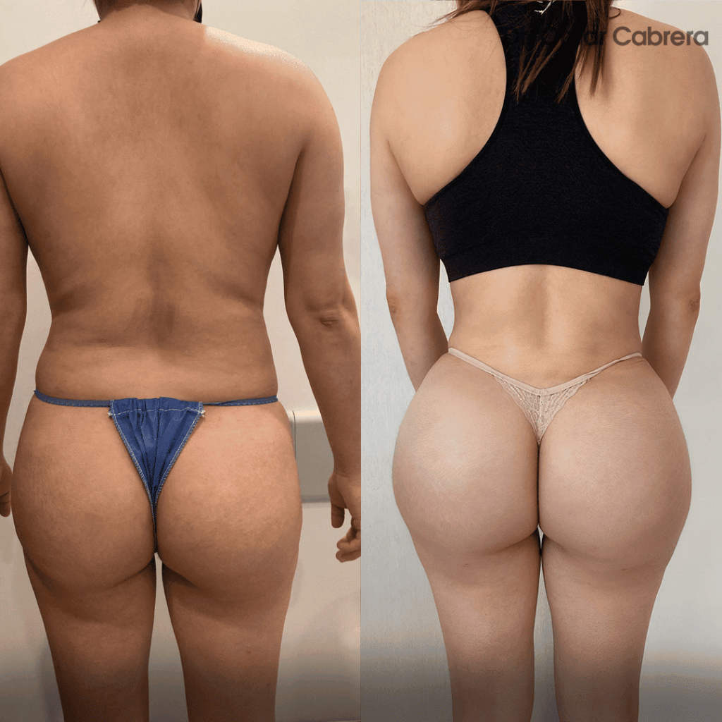 BBL Tijuana Lipotransferencia. Dr Omar Cabrera. Cirujano plastico en tijuana mexico (1)