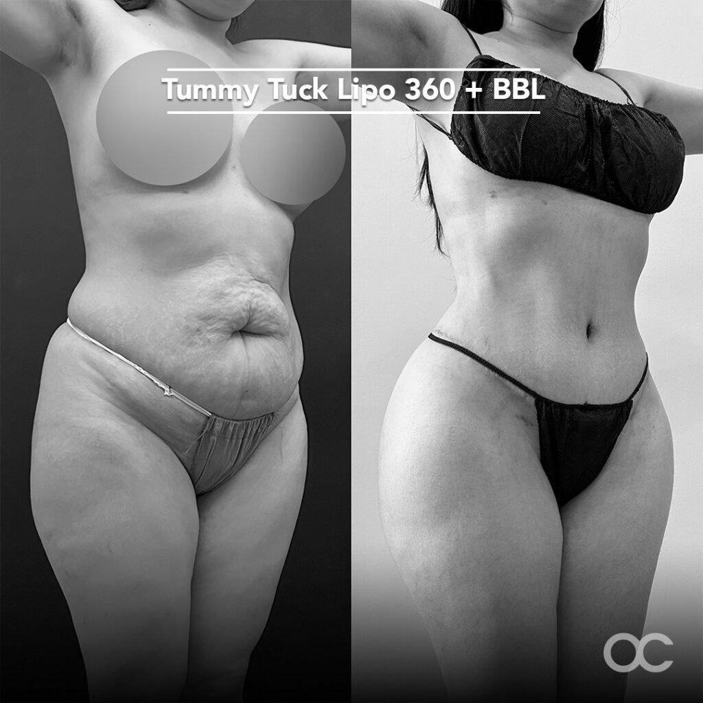 Abdominoplastia y Tummy Tuck Tijuana. Dr Omar Cabrera (11)