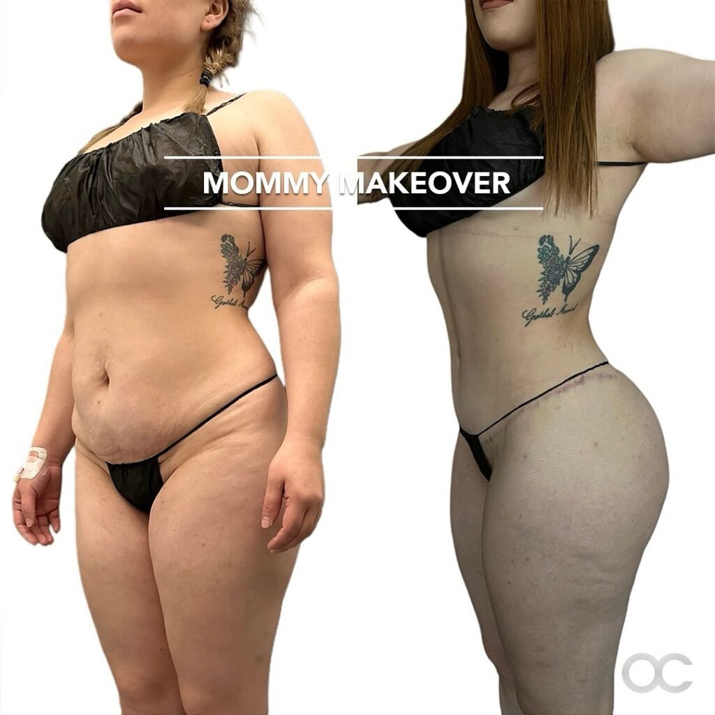 Mommy Makeover Tijuana. Dr Omar Cabrera (20)