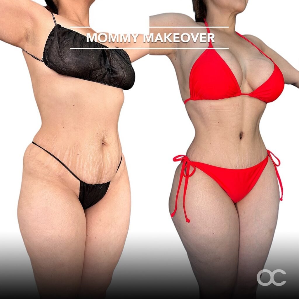 Mommy Makeover Tijuana. Dr Omar Cabrera (5)